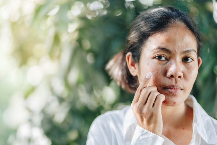 hormonal acne causes, hormonal acne jawline, hormonal acne chin, adult acne hormones, hormonal breakouts women, how to treat hormonal acne, palo alto, Semper Amate Skin Care 