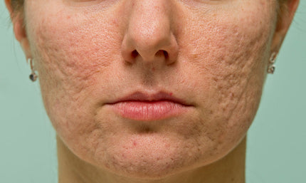 post-inflammatory hyperpigmentation, acne dark marks, how to fade acne marks, acne scarring treatment, mandelic acid PIH, acne marks vs scars ,Palo Alto, Peninsula, Bay Area, Menlo Park, Redwood City, San Jose, Mountain View