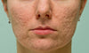 post-inflammatory hyperpigmentation, acne dark marks, how to fade acne marks, acne scarring treatment, mandelic acid PIH, acne marks vs scars ,Palo Alto, Peninsula, Bay Area, Menlo Park, Redwood City, San Jose, Mountain View
